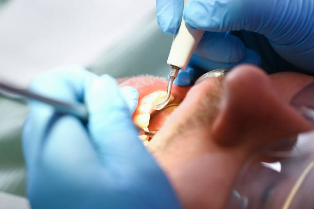 Best Emergency Tooth Extraction in Gonzalez, FL